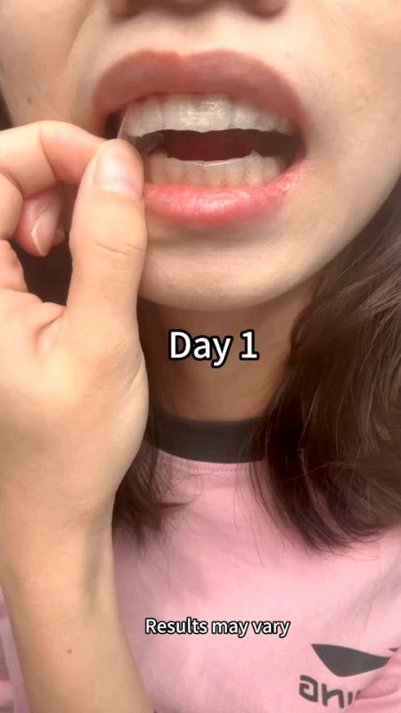 #teethwhitening #whiteningstrip #TeethTreatment #scalingteeth #cleanteeth #whiteteeth #HealthyTeeth #dentistrecommended #SmileConfidently